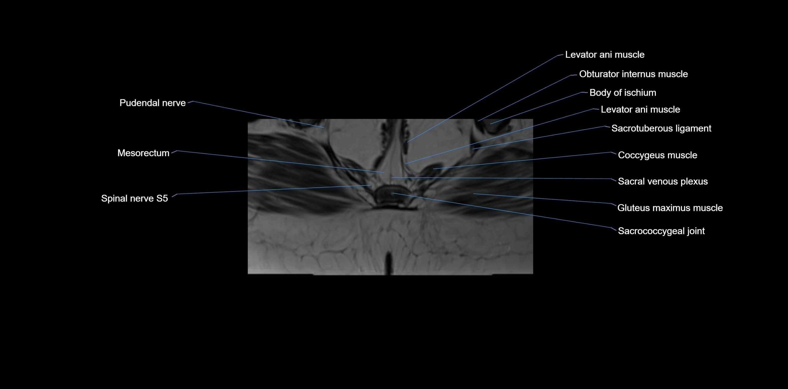 MRI sacrum, coccyx and sacroiliac joint axial cross sectional anatomy 3T  radiology  image-img-00001-00066.webp